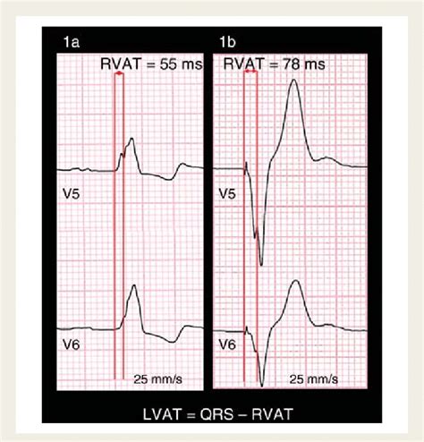 pacing to left ventricular activation time